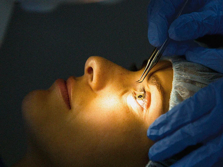 What You Need to Know About Eye Laser Surgery